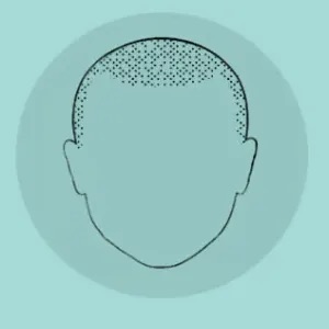 Schéma : points de pigment semés sur le dessus du crâne pour combler une zone clairsemée