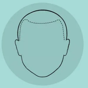 Schéma : tracé en pointillés d'une nouvelle ligne de naissance des cheveux, plus basse
