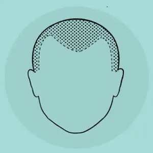 Schéma : zone frontale densément pigmentée, pour un effet de cheveux fraîchement rasés